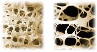Osteoporose Knochen